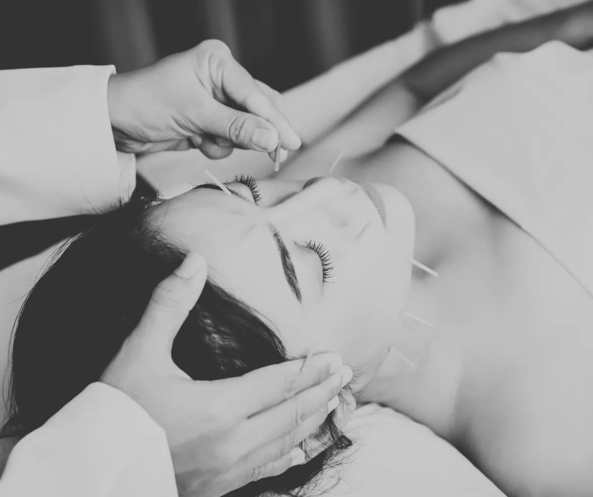 Acupuncture faciale