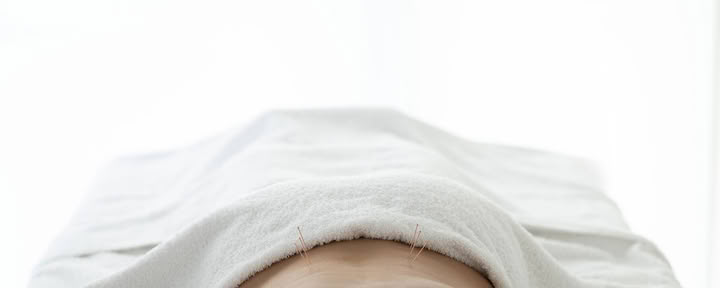 Acupuncture