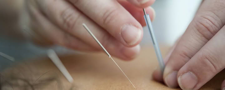 $95 Première visite - Séance d'acupuncture