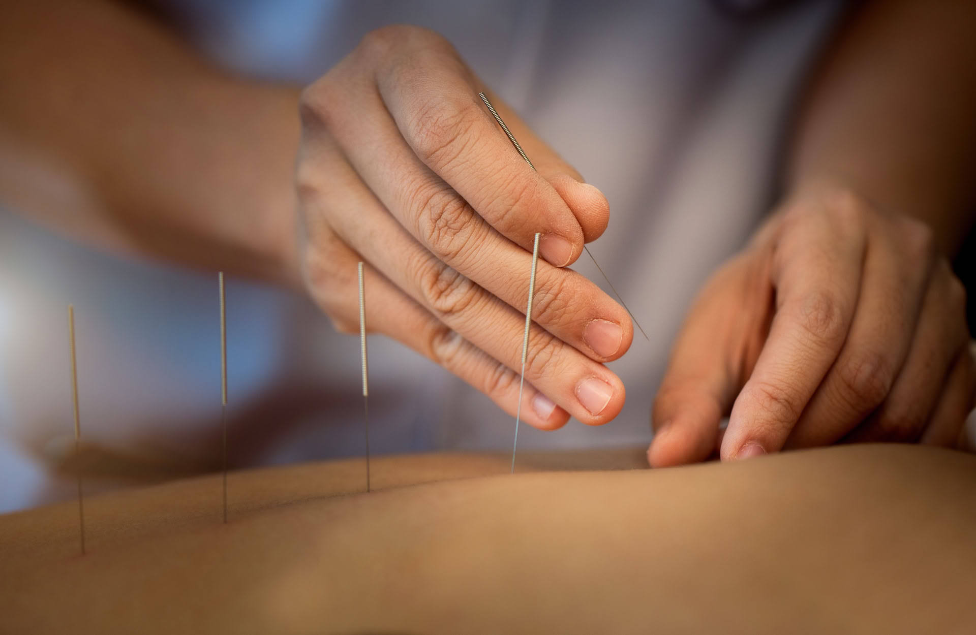 Séance de thérapie d’acupuncture individuelle à Ubud