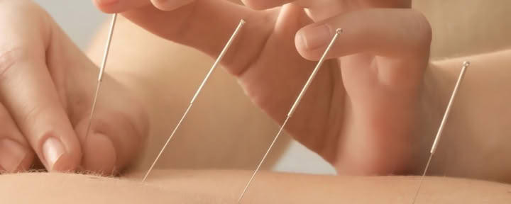 Séance de thérapie d’acupuncture individuelle à Ubud